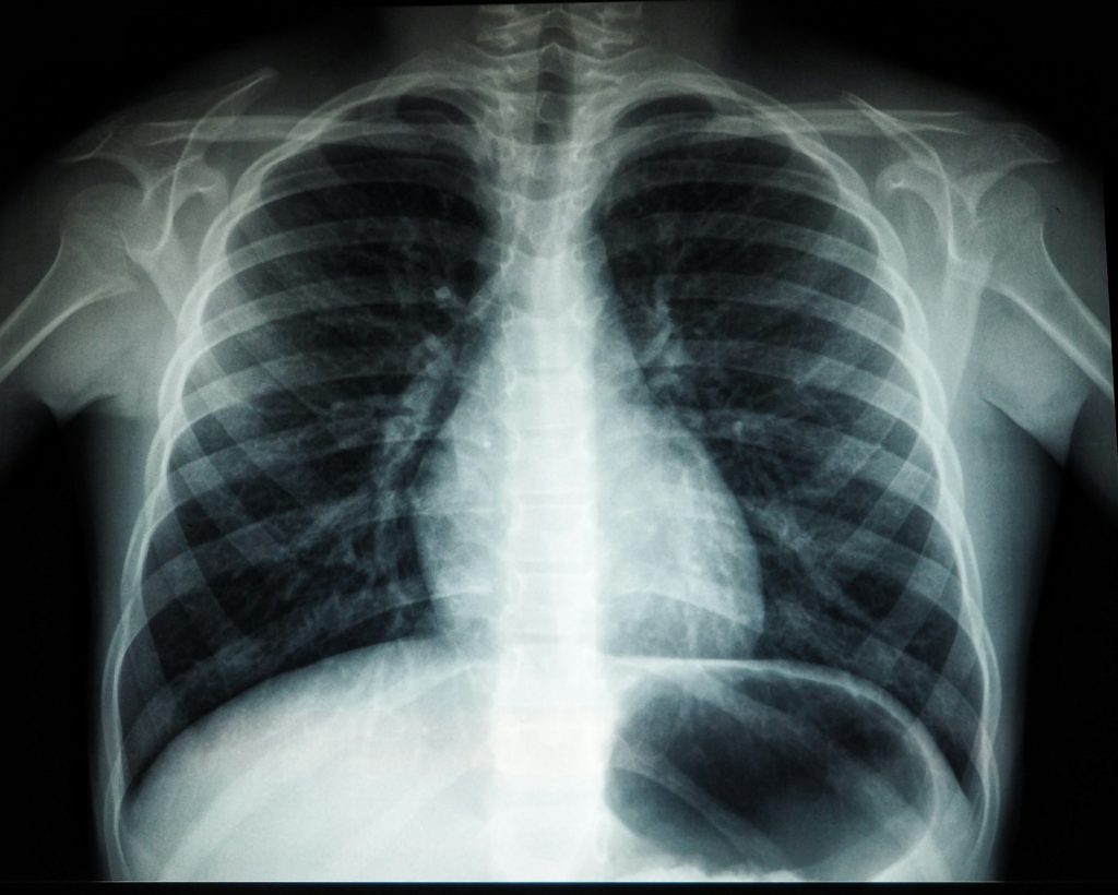 Chest X-ray showing lungs and heart structure for respiratory diagnosis